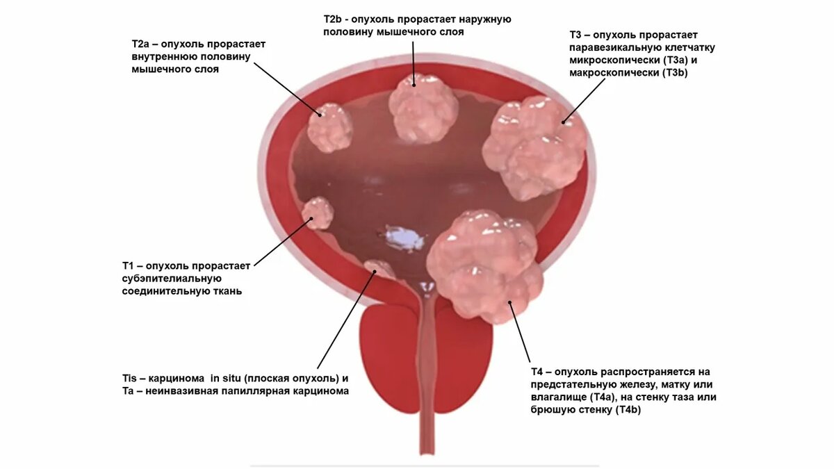 Стадии рака