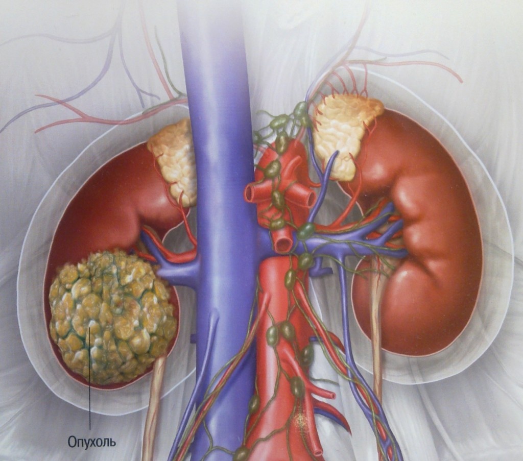 Опухоль нижнего полюса правой почки