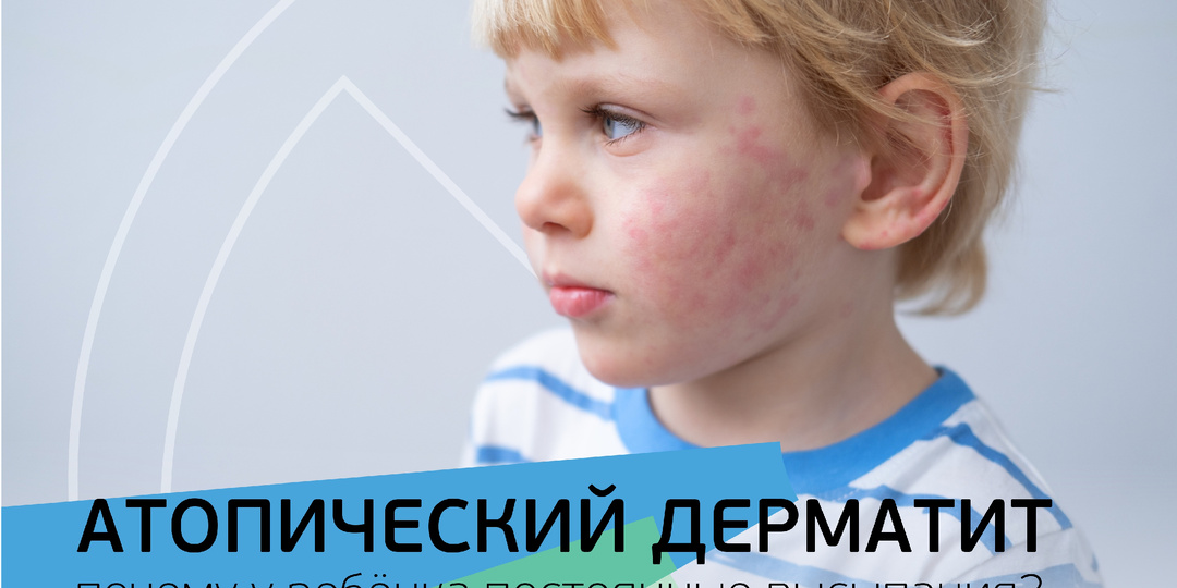 Атопический дерматит. Почему у ребёнка постоянные высыпания?