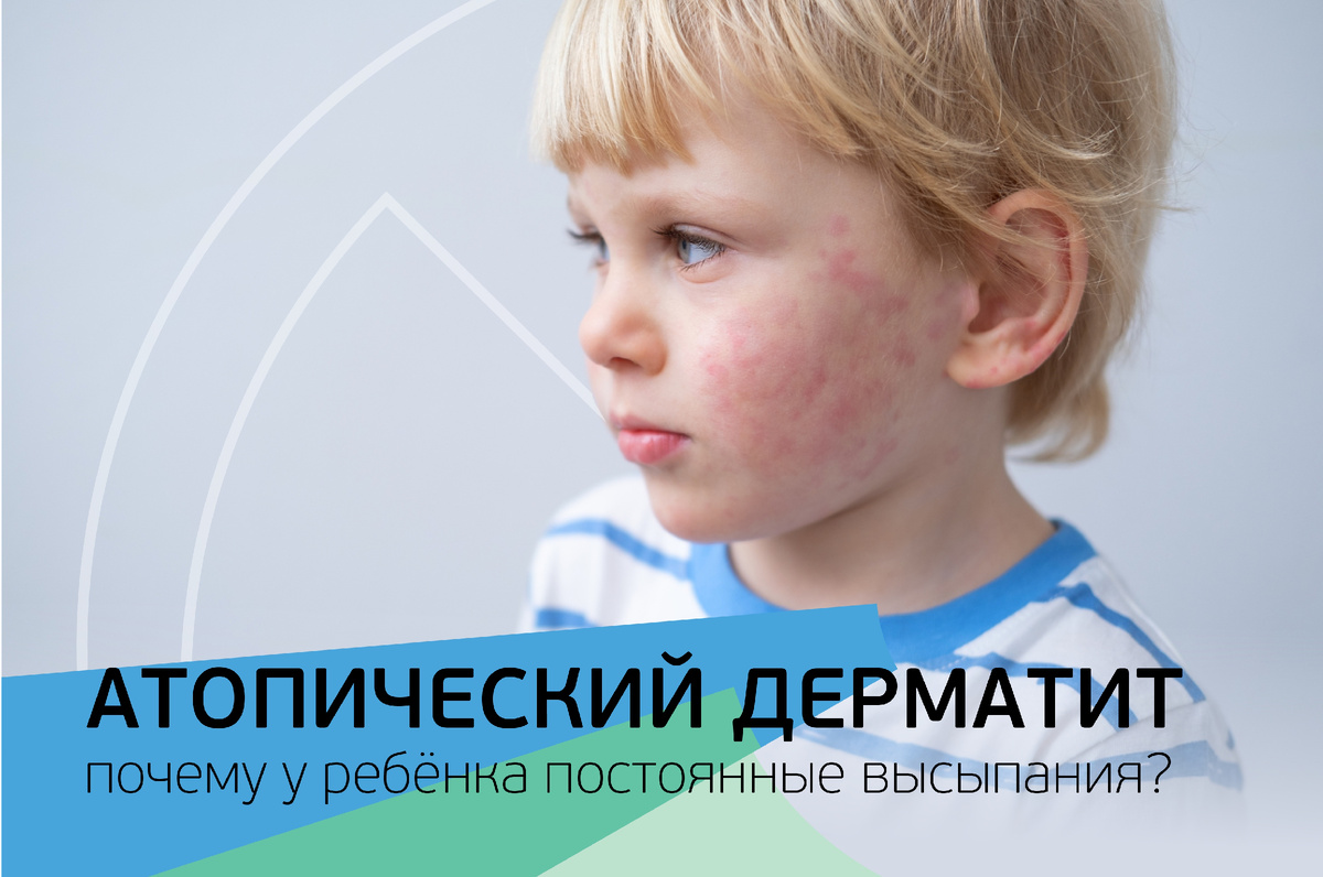 Атопический дерматит. Почему у ребёнка постоянные высыпания?