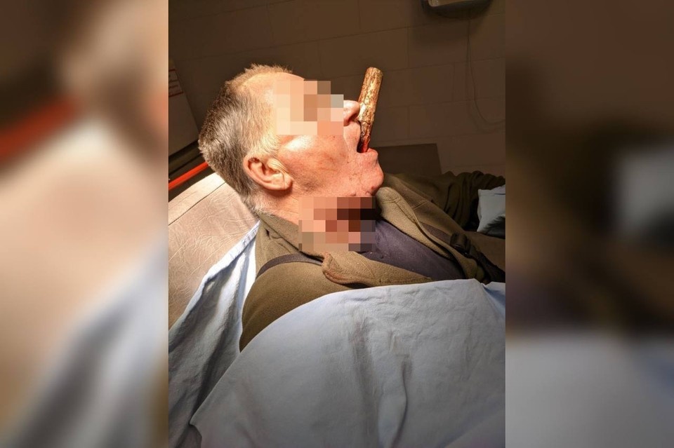    Красноярские хирурги спасли мужчину, проткнувшего себе челюсть черенком. Фото: Александр Геранимус