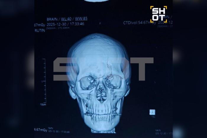 Россиянин попал в страшное ДТП на Бали, у него паралич позвоночника и жуткие переломы. Фото © SHOT