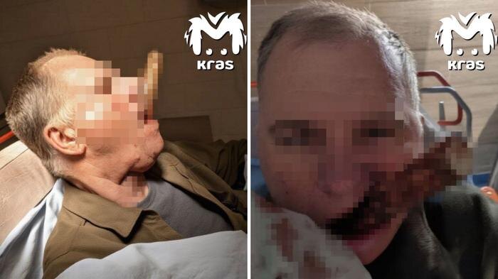 Черенок от лопаты пробил шею жителю Красноярска и вышел через рот. Обложка © Telegram / Kras Mash