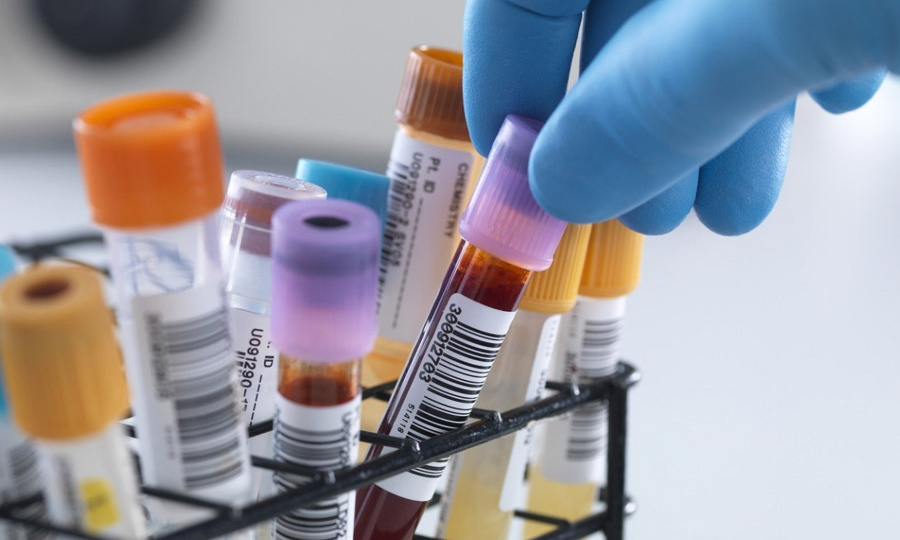 Холестерин уходит на второй план: ученые назвали более точный индикатор угрозы для сердца