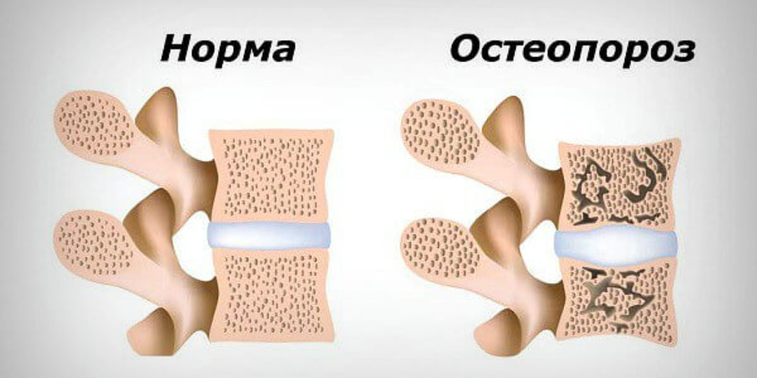 Тихая болезнь костей: можно ли остановить остеопороз после 50? Отвечает эндокринолог
