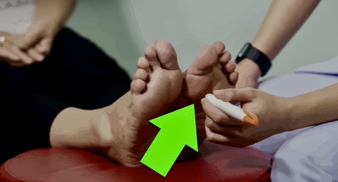 Легкая или средняя степень диабетической нейропатии (онемение, снижение чувствительности в ногах).