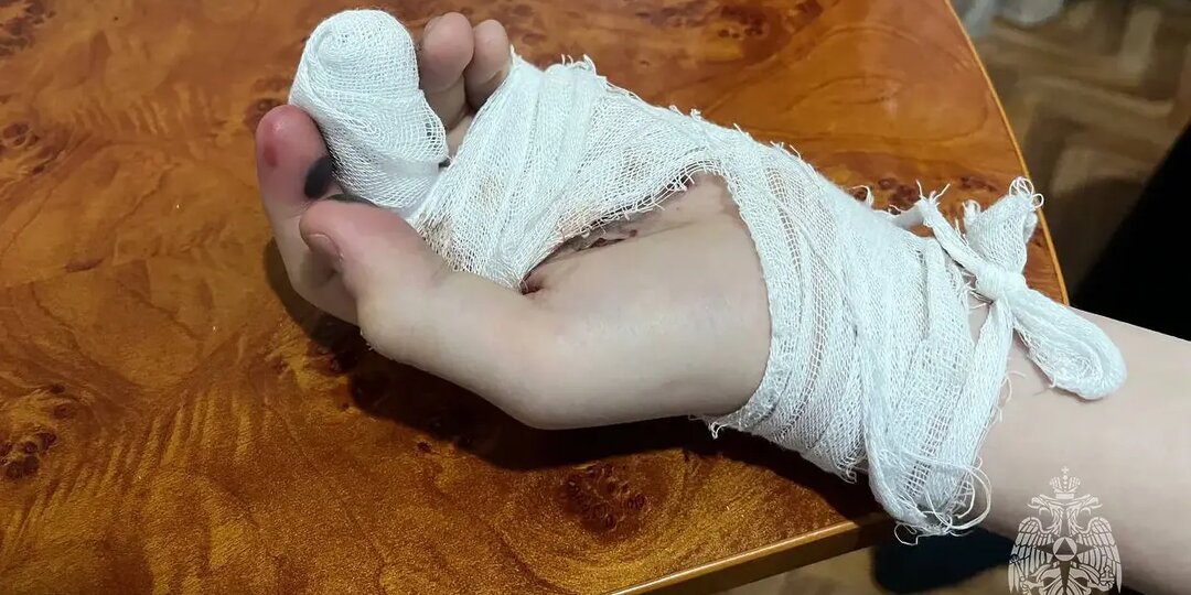 12-летний мальчик пострадал при взрыве петарды в Удмуртии