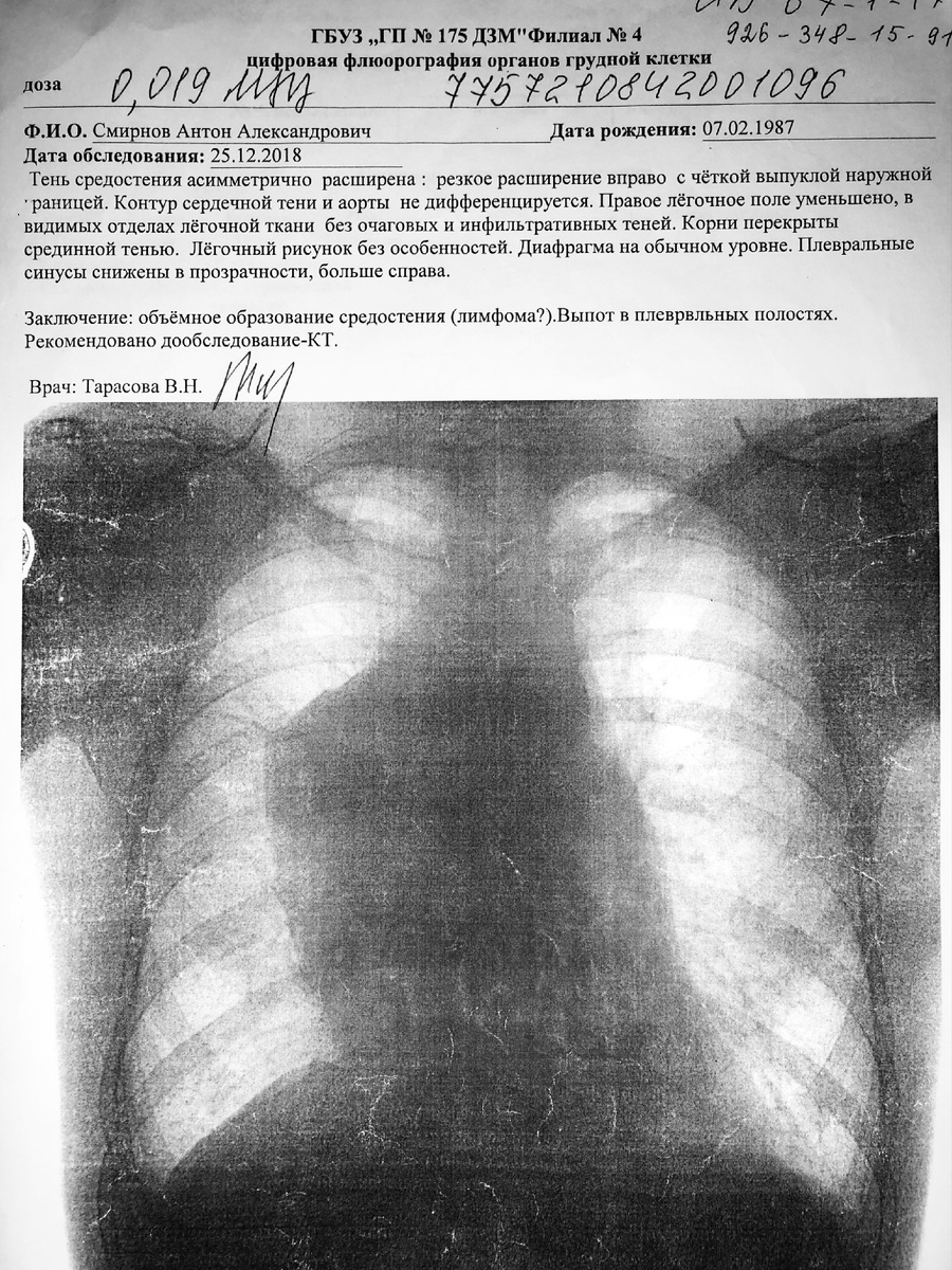 Заключение флюорографии моих органов грудной клетки от 25.12.2018