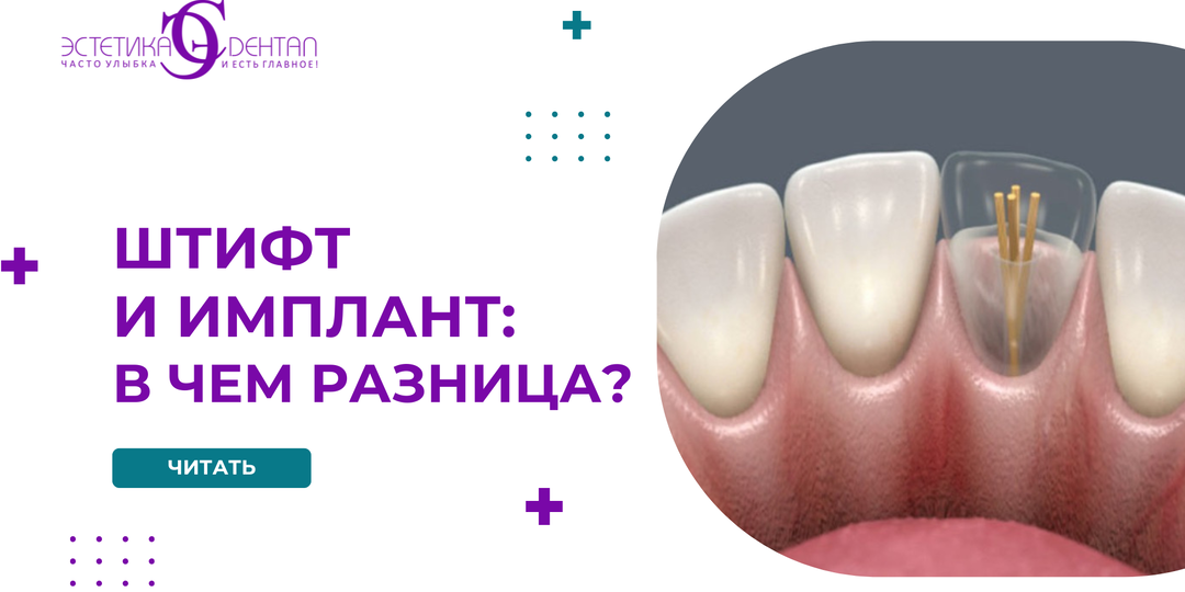 Штифт и имплант:в чем разница?