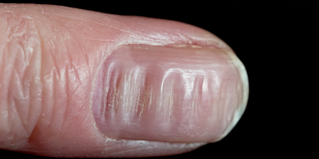 Ребристые ногти: о каких проблемах в организме они предупреждают