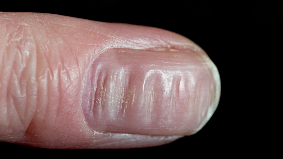 Ребристые ногти: о каких проблемах в организме они предупреждают