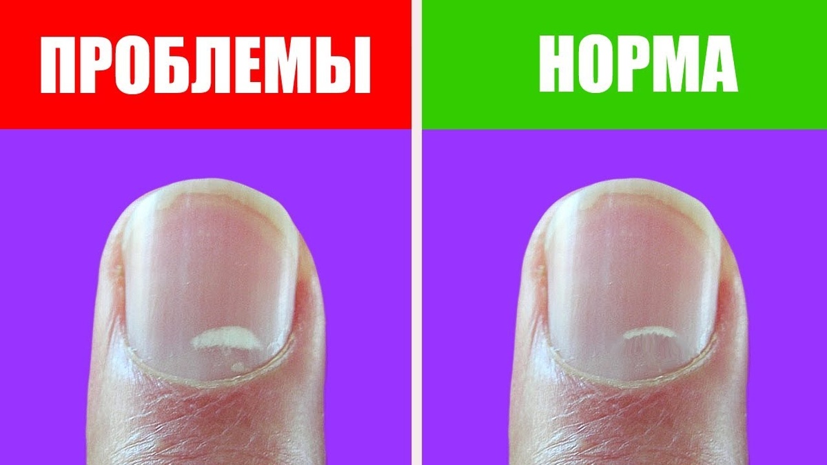 Белые пятна на ногтях — это не дефицит кальция: что говорят врачи