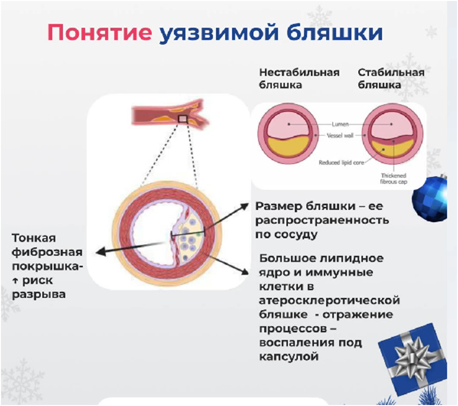 Ведь даже бляшка в сосуде - еще не приговор, еще можно побороться за свое здоровье