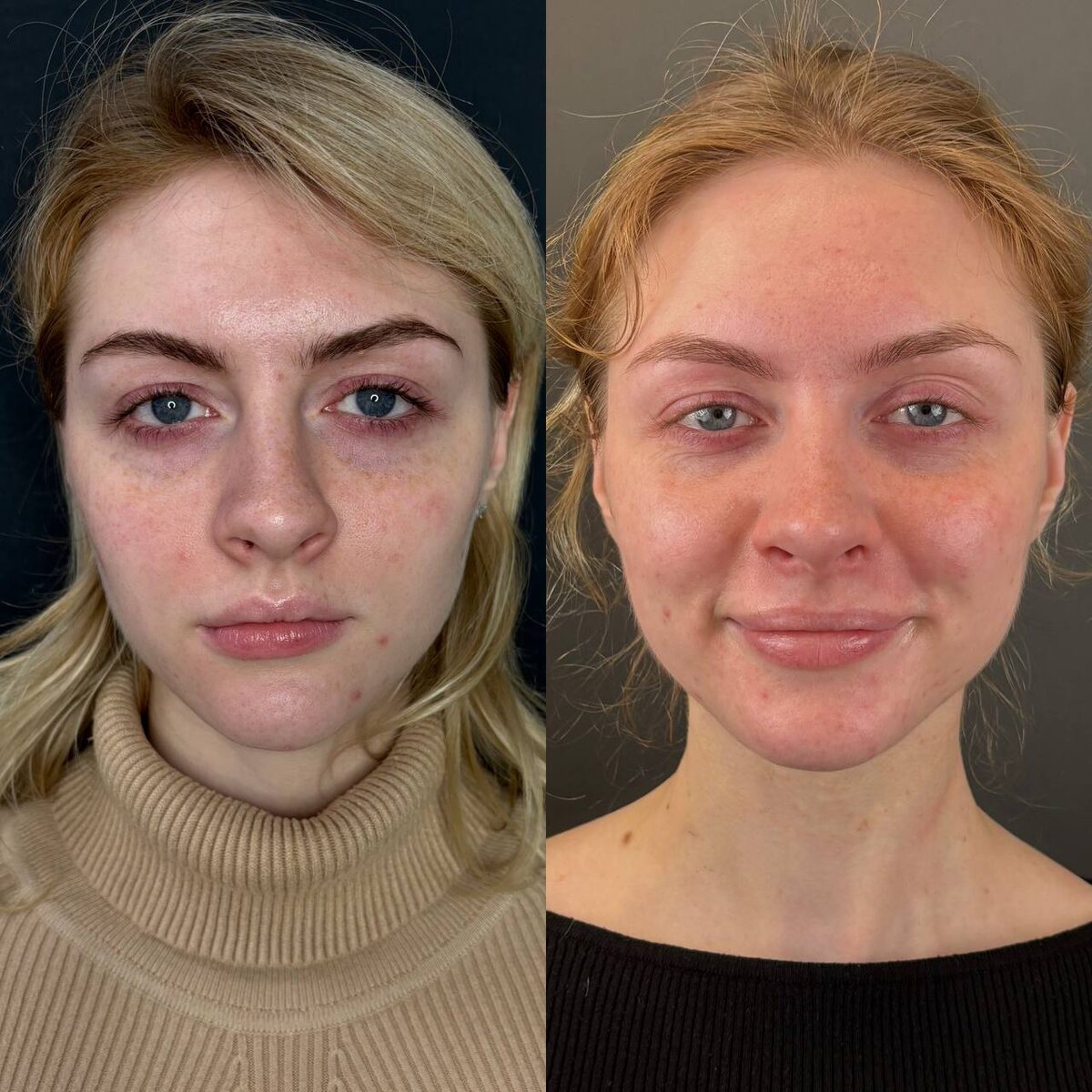 Слева- до операции риносептопластика, справа- через 1 год после. Хирург Остринская Т. В.