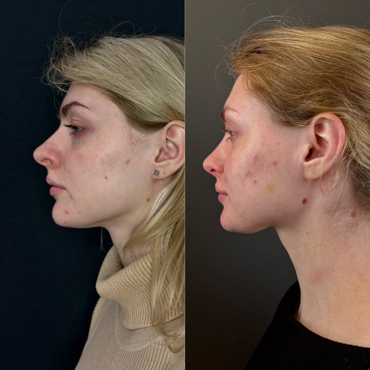 Слева- до операции риносептопластика, справа- через 1 год после. Хирург Остринская Т. В.