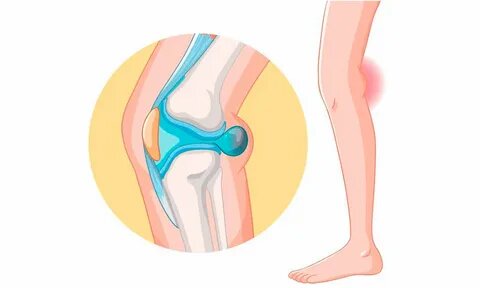 Боль под коленом: когда стоит бить тревогу