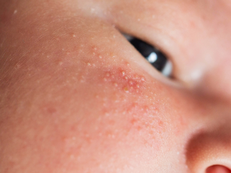«Цветение» или акне новорожденных