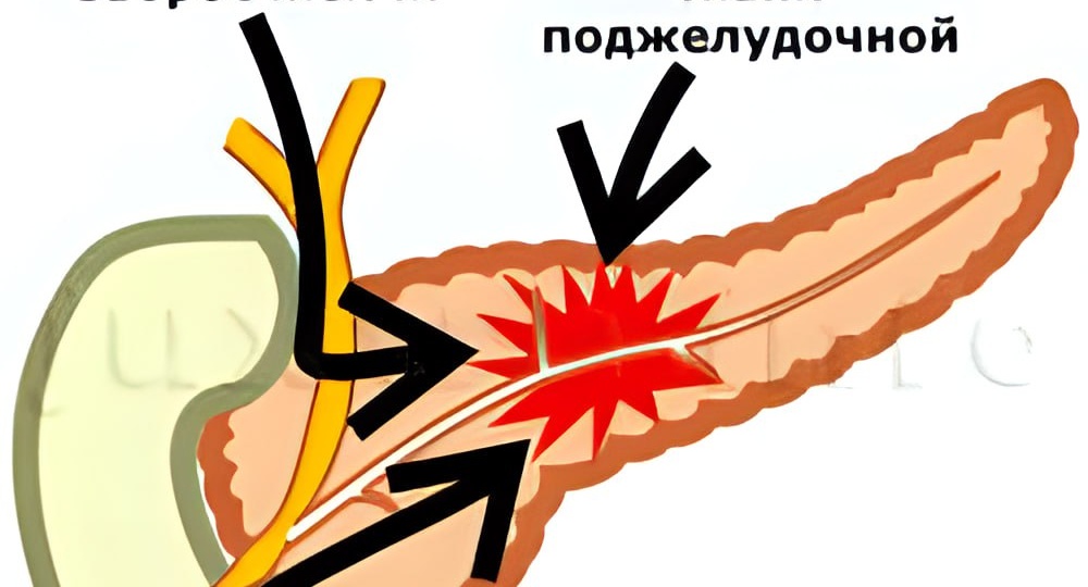 ЗАСТОЙ ЖЕЛЧИ и ПАНКРЕАТИТ