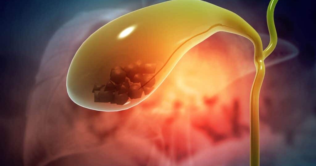 10 распространённых мифов и правда о камнях в желчном пузыре