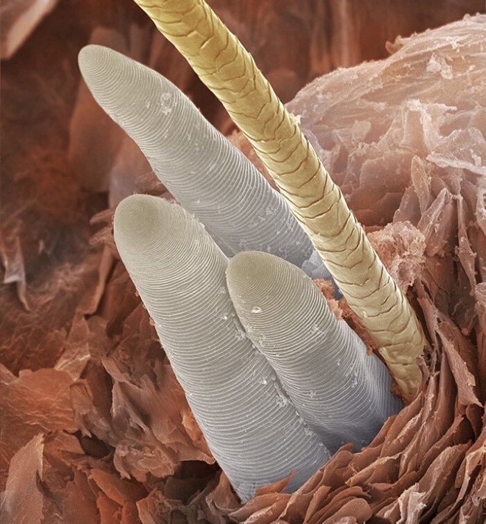 Три "хвоста" угревых железниц торчат из фолликула рядом с волоском. Фото с сайта https://psmicrographs.com/