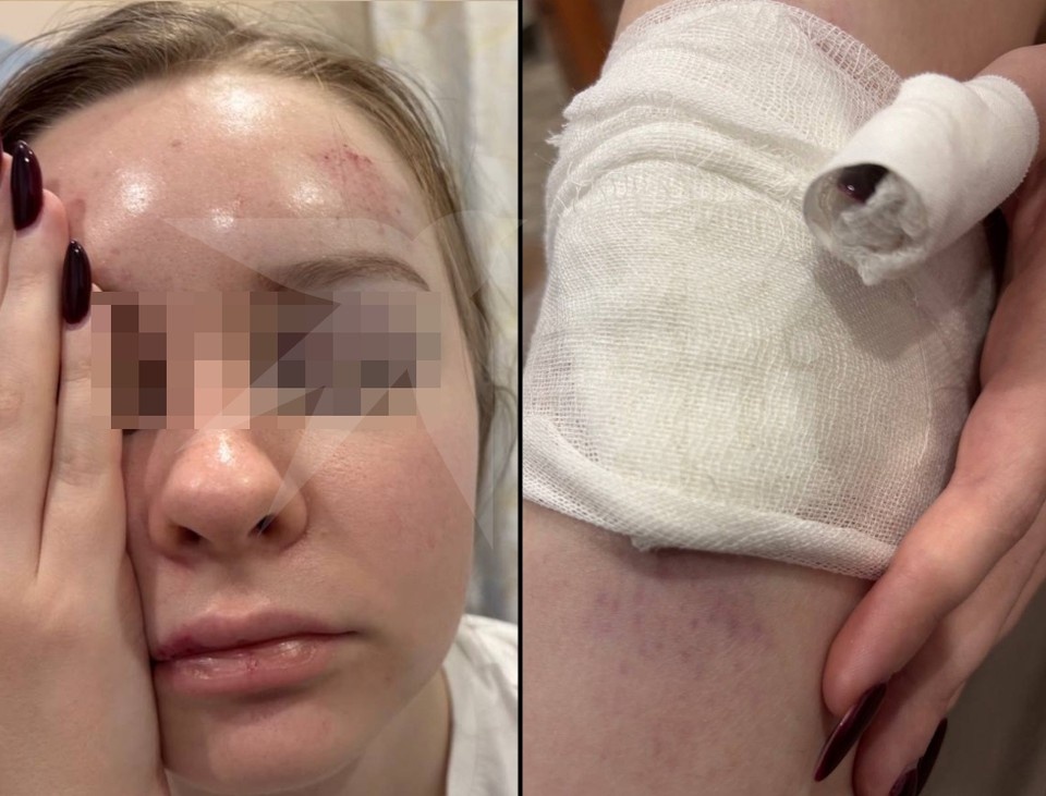    Травмы Олеси. Фото: предоставлено "КП-Петербург"