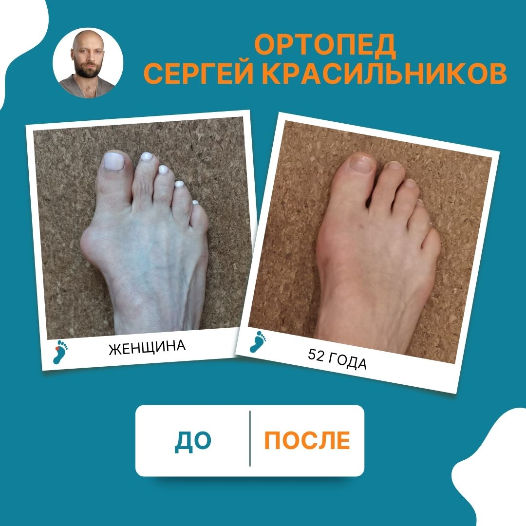 На фото: стопа пациентки 52 лет: до операции и через 3 месяца после чрескожной коррекции. Результат говорит сам за себя.