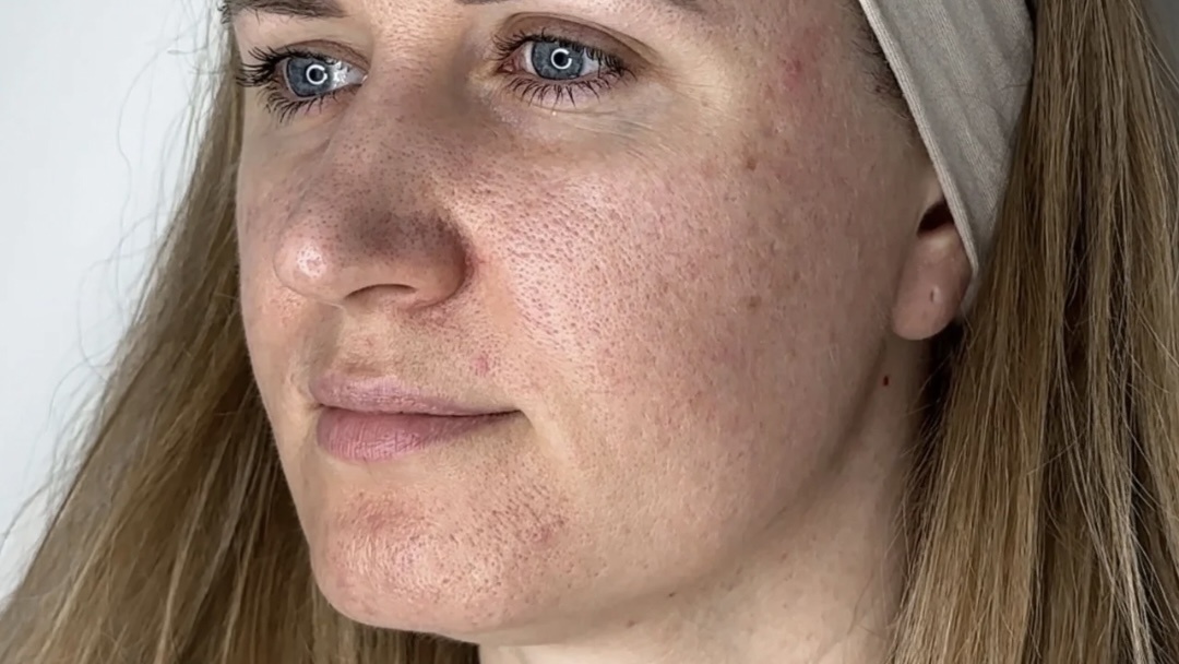 до процедуры RF-лифтинга