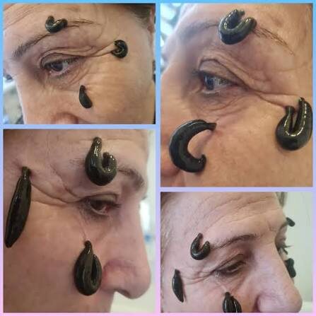 Альтернативное лечение глаукомы.