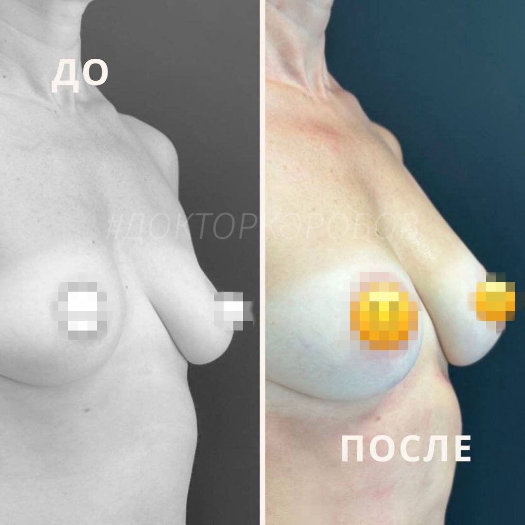 Липофилинг груди (увеличение груди с использованием собственного жира). Результат через 1 год.
