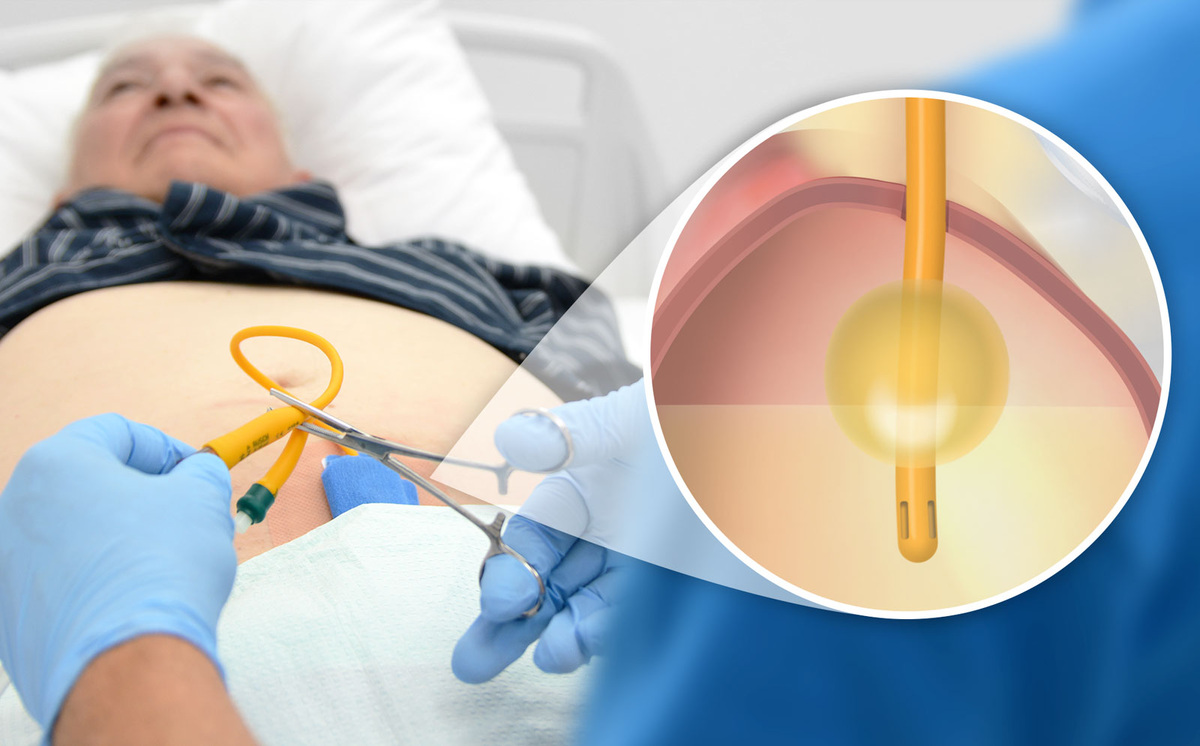 Катетеризация мочевого пузыря