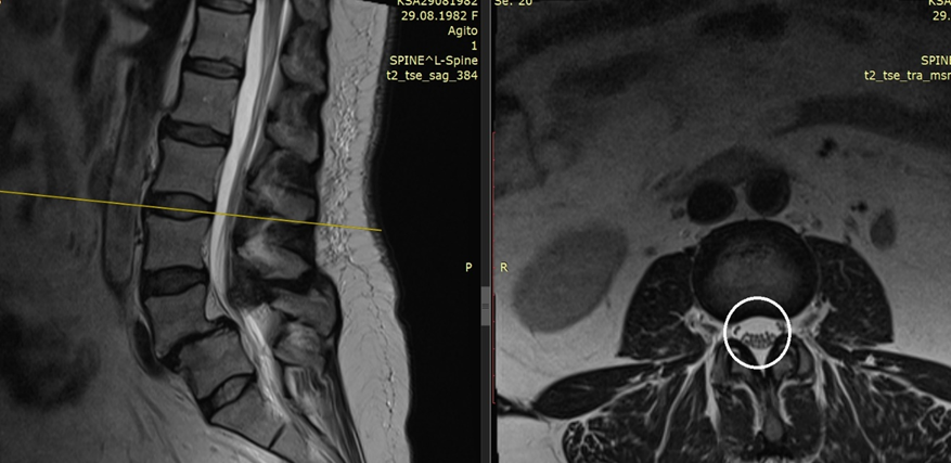 Нормальный размер позвоночнго канала - обведено белым кругом 
