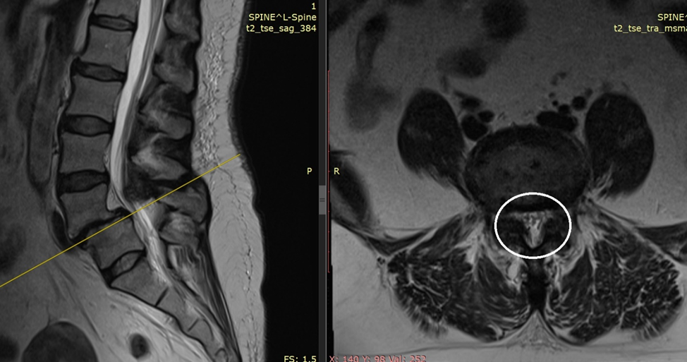 Узость позвоночного канала на фоне листеза вследствии спондилолиза - обведено белым кругом 