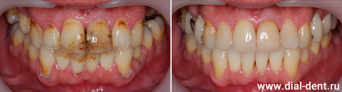 проведена композитная реставрация передних зубов и бюгельное протезирование