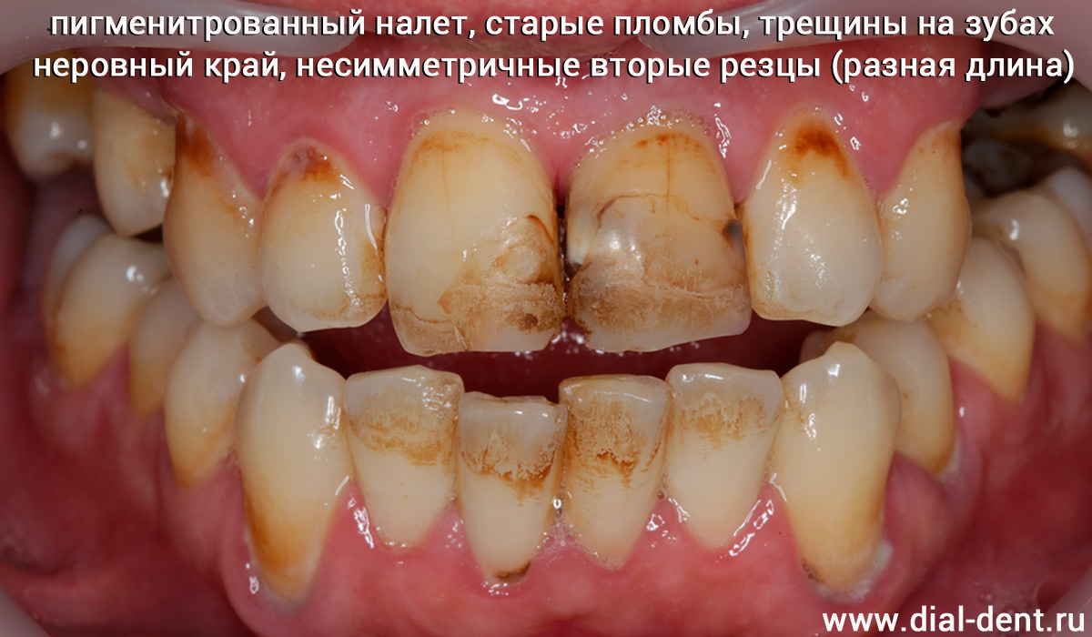 неудовлетворительная эстетика передних зубов и отсутствие верхних жевательных зубов