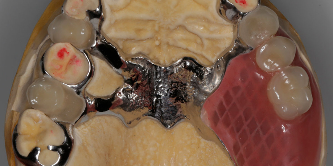 Гигиена полости рта, лечение кариеса, художественная реставрация передних зубов и бюгельное протезирование боковых зубов