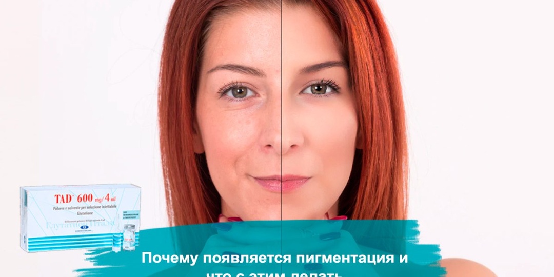 Почему появляется пигментация и что с этим делать