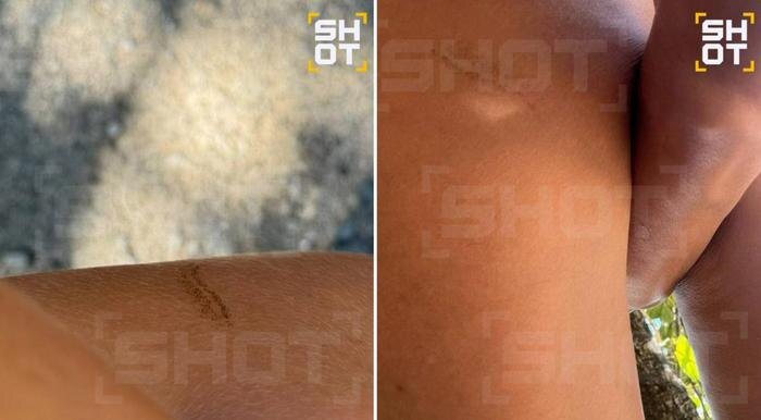 Последствия укуса. Фото © SHOT