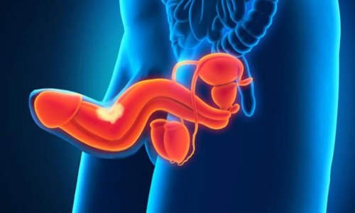 искривление полового органа