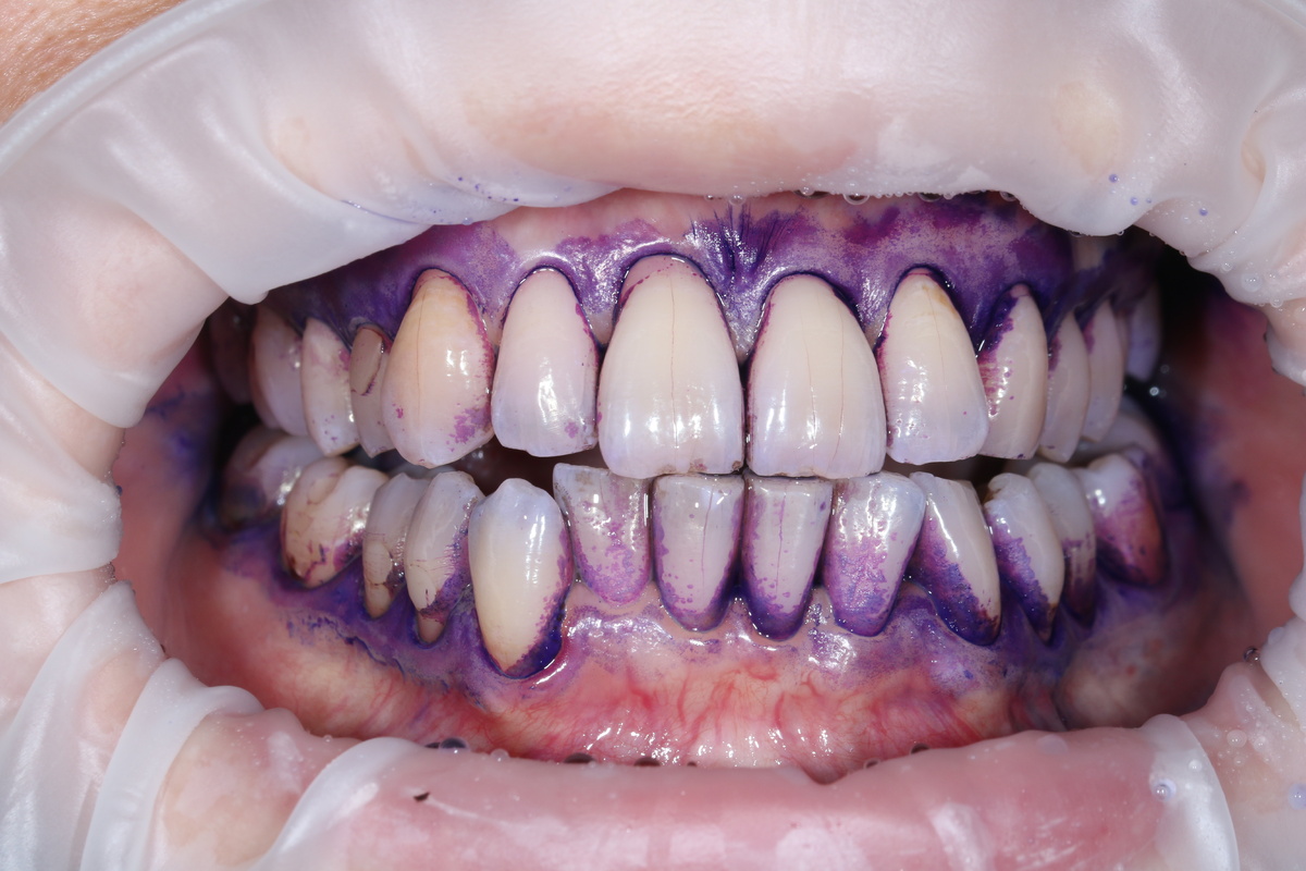 До. быстрое образование тёмного налёта и зубного камня.