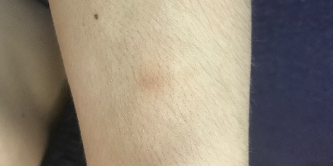 Синяки появляются сами по себе: что с сосудами