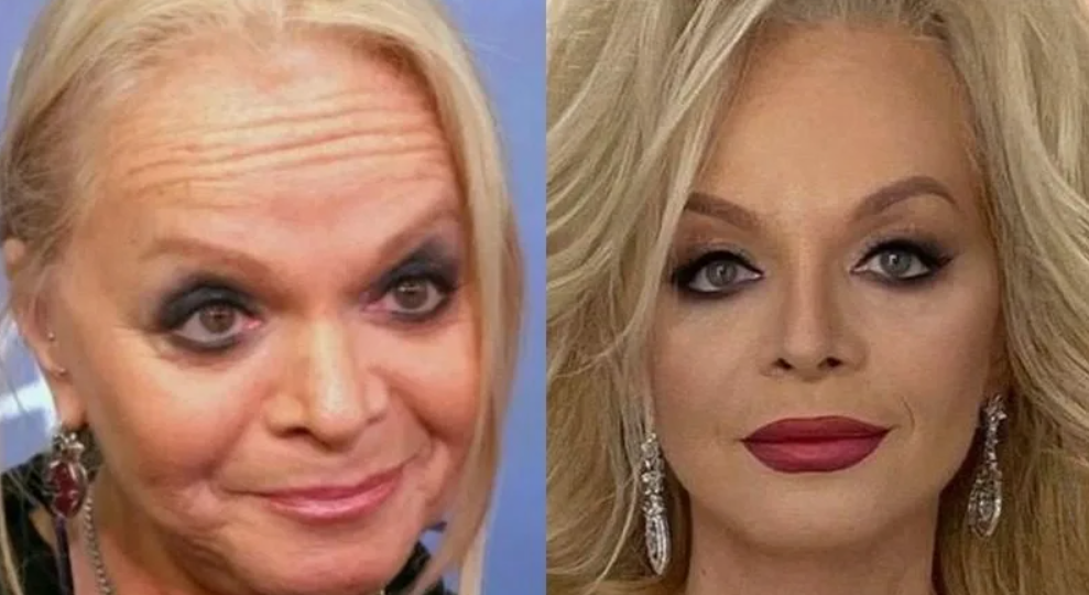 7 знаменитостей, красоту которых уничтожила пластика