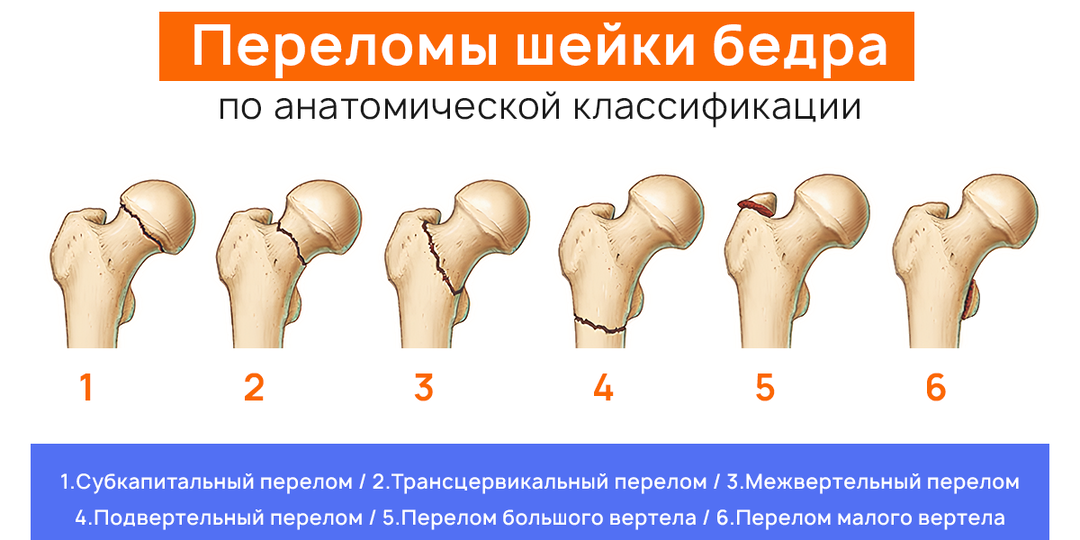 Переломы шейки бедра: когда выбрать остеосинтез, а когда — эндопротезирование?