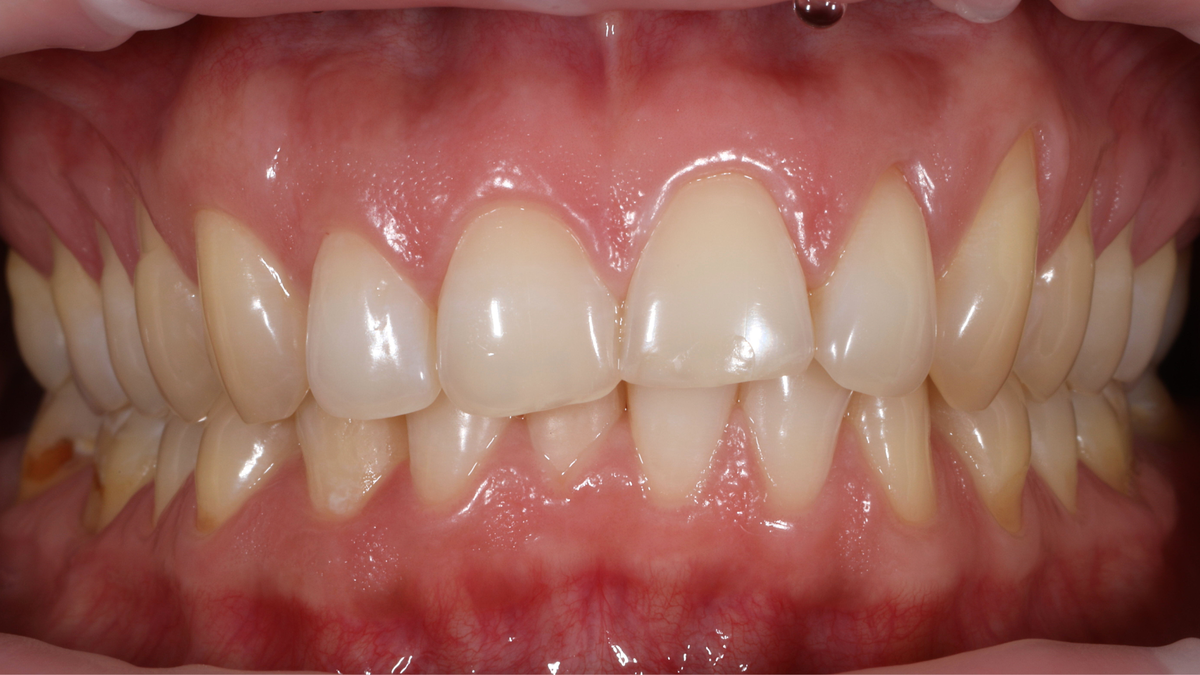 Фото ротовой полости нашей пациентки на момент обращения в ПРАЙМ.