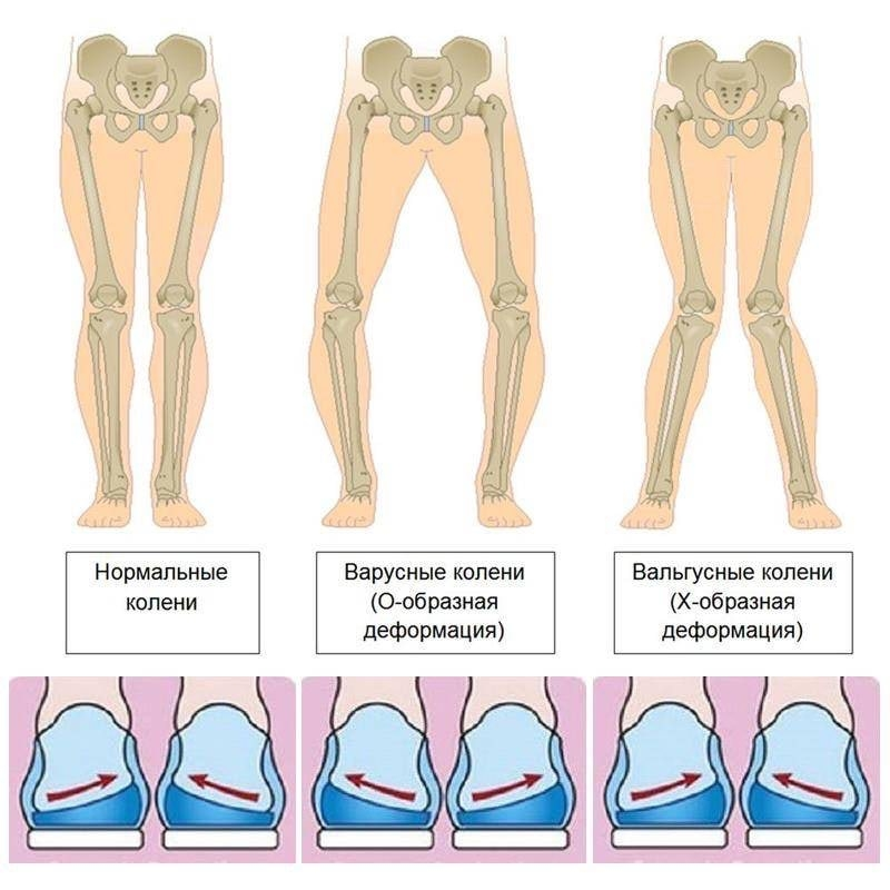 Вальгус стопы → колени → таз: как ломается ось тела