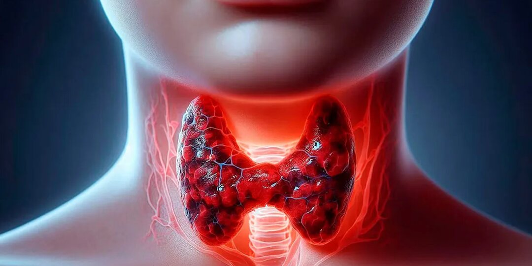 Узлы в щитовидной железе: не паниковать, а понимать