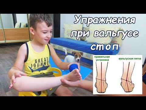 Почему упражнения при вальгусе не работают: главные ошибки