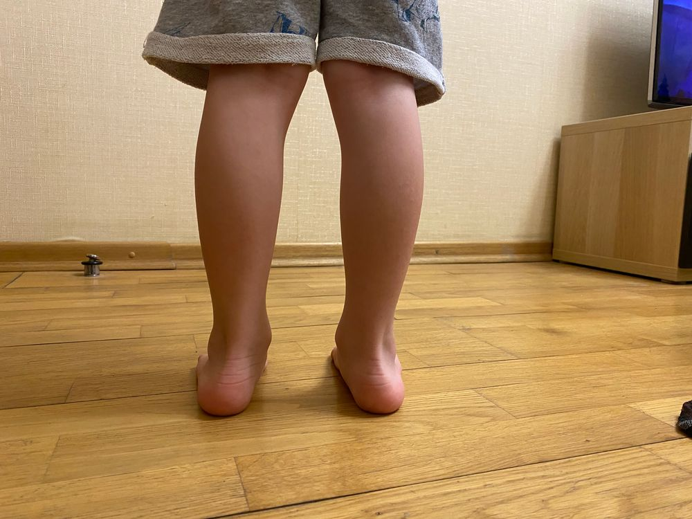 Детский вальгус: что важно знать родителям