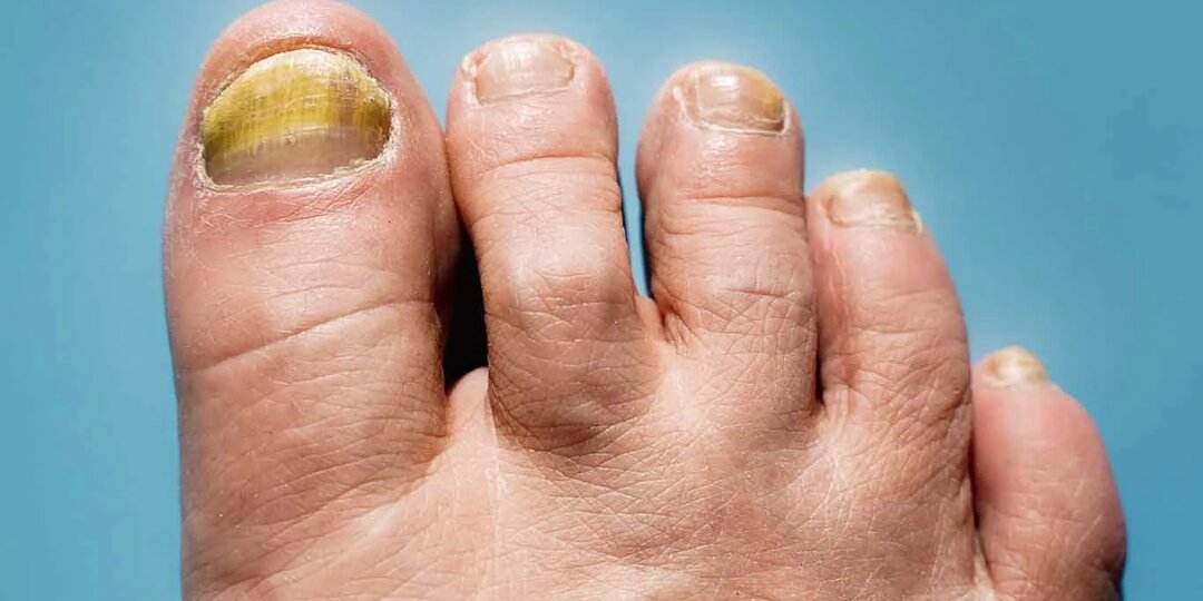 Грибок ногтей и кожи: как распознать, можно ли верить рекламе и чем действительно вылечить?