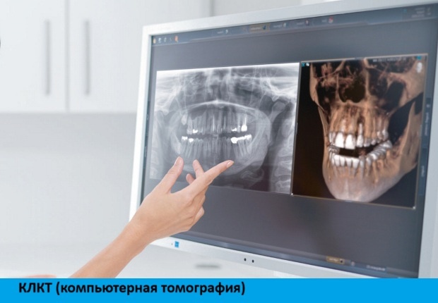 КЛКТ (компьютерная томография)