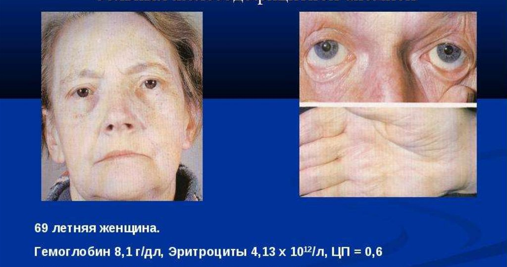 Поговорим про общий анализ крови и анемию